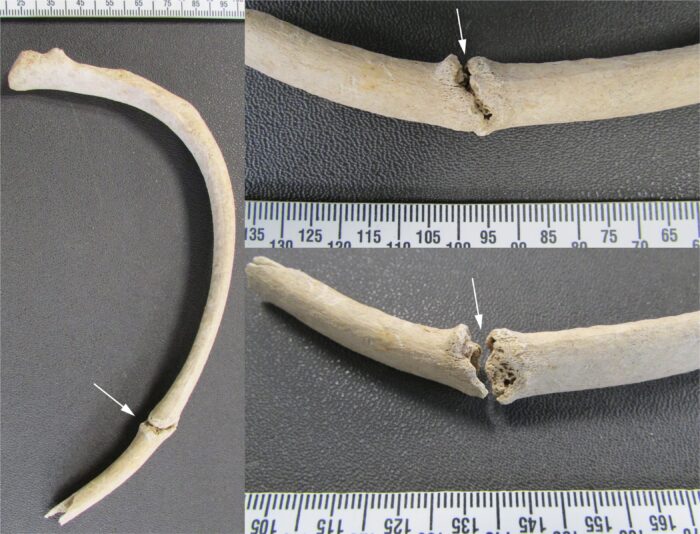 broken rib with arrow indication and scale ruler
