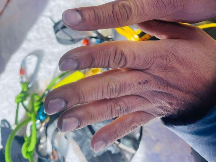 hands with slightly blue fingertips.