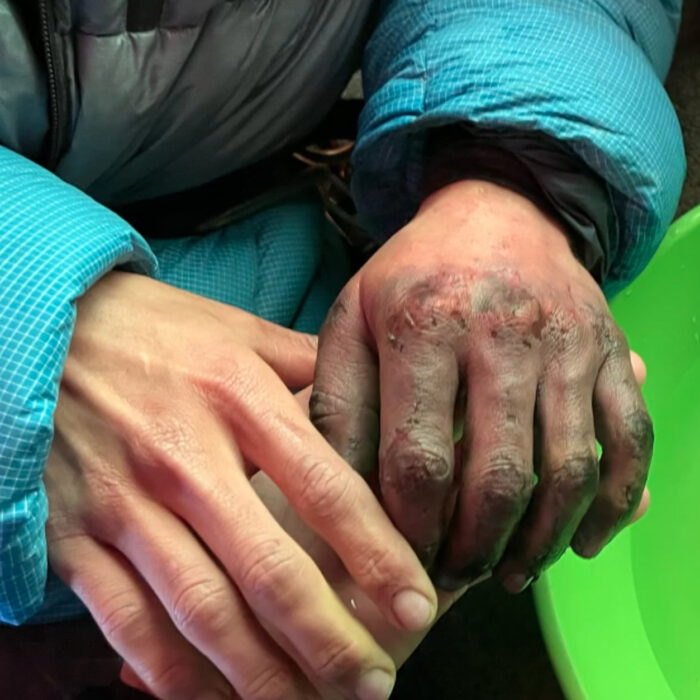 Close shot of a climber's hand, injured in a fall in a crevasse on Annapurna.