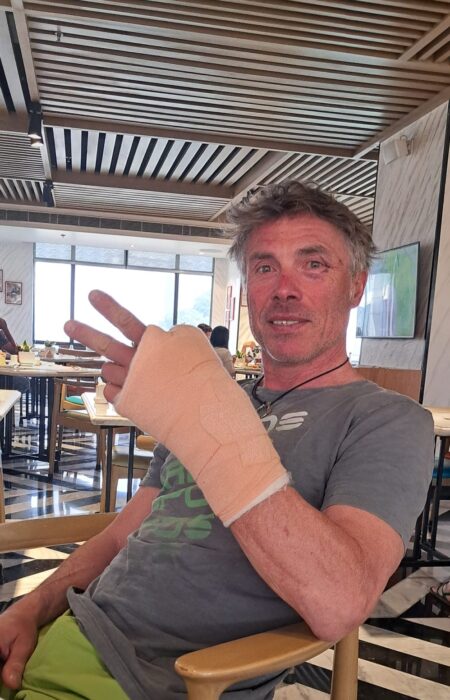 Cavalli in a restaurrant in Kathmandu with bruised head and bandaged hand