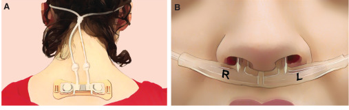 An illustration of a device attached to the nape of a neck and then to the nostrils