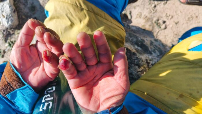 Injured hands of a sherpa. 