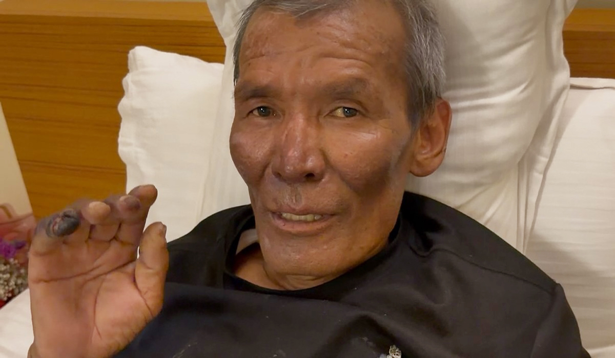 Close shot of injured Dawa Sherpa in bed.