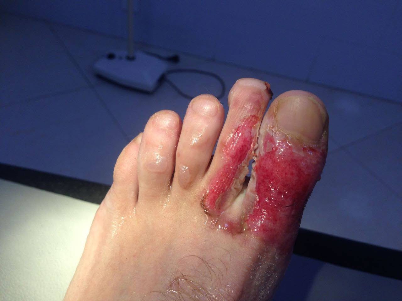 My foot after the blisters were burst and the wound was cleaned.